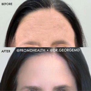 Improve The Appearance Of Wrinkles And Fine Lines By Relaxing Muscles In Treated Area(s) By George Gavrila, MD,Baltimore