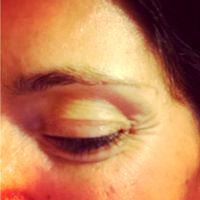 Injectable Relaxers, Such As Botox, Flatten And Smooth Deep Wrinkles