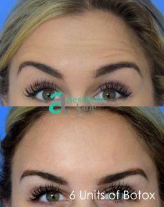 Madie-Forehead-Front-812x