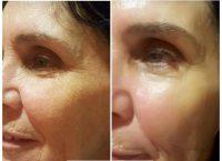 OnabotulinumtoxinA With Dr. Ali Adibfar, Toronto Plastic Surgeon