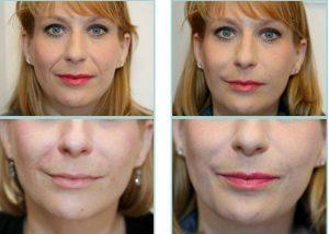 Radiesse By Dr. Jodie Reinertson MD, Seattle