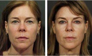 Sculptra, Botox By Dr. Rebecca Fitzgerald,M.D.,Beverly Hills