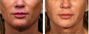 Sculptra, Botox,Juvederm Fillers By Dr. Rebecca Fitzgerald,M.D.,Beverly Hills