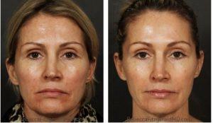 Sculptra, Botox,Juvederm Treatment By Dr. Rebecca Fitzgerald,M.D.,Beverly Hills