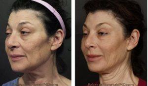 Sculptra, Juvederm, Botox By Dr. Rebecca Fitzgerald,M.D.,Beverly Hills