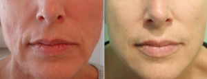 Sculptra Post 2 Vials At 11months By Michelle Boone, ARNP-BC,Orlando