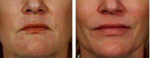 Sculptra, Restylane, Botox Masseter Treatment By Dr. Rebecca Fitzgerald,M.D.,Beverly Hills