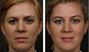Sculptra Treatment By Dr. Rebecca Fitzgerald,M.D.,Beverly Hills
