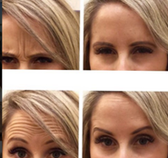 Take Away Lines And Wrinkles With Botox At The SkinSpirit Skincare Clinic And Spa,Seattle