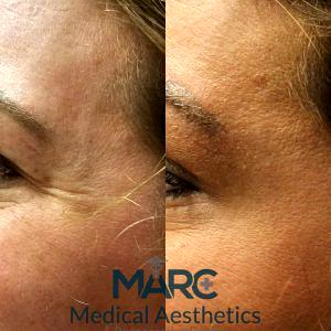 Teeny Tiny Dose Of Botox To Treat This Patient's Crow's Feet By Dr. Rey Bello, MD,Knoxville