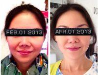 The Botox By Dr Daniel P. Markmann, Baltimore Plastic Surgeon