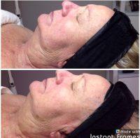 There Is No Downtime Or Recovery Time Needed After Botox Treatment Session