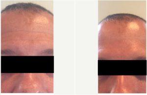 Treated With Dysport By Jessica H. Kim, MD,Seattle