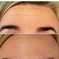 Treatment Used To Treat Lines In The Face