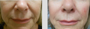 Voluma Filler By Michelle Boone, ARNP-BC,Orlando