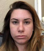 What Is BOTOX And How Does It Work