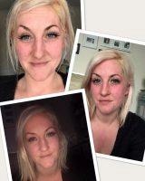 Which Wrinkles Can Botox Treat