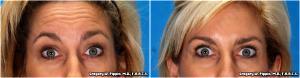 Wrinkes Treatment With Botox By Gregory W. Pippin, M.D., F.A.A.C.S.,New Orleans