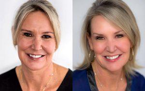 Wrinkles Treatment With Dysport By Dr. Michele Shermak, MD,Baltimore