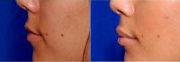 25 Year Old Woman Treated With Juvederm To The Lips Before With Dr Sean R. Weiss, MD, FACS, New Orleans Facial Plastic Surgeon