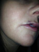 Botox OnabotulinumtoxinA Injection Pic By Doctor Rey N. Bello, MD, Knoxville Physician