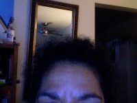 Botox Type A Image By Dr. James McMahan, MD, Columbus Board Certified Plastic Surgeon