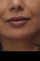 Botox Type A With Dr. Daniel Levy, MD, Bellevue Dermatologic Surgeon, Board Certified In Dermatology