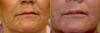 Doctor Scott K. Thompson, MD, Salt Lake City Facial Plastic Surgeon - Juvederm