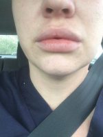 Dr Arian Mowlavi, MD, FACS, Laguna Beach Board Certified Plastic Surgeon Botox Injections Picture