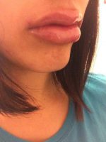 Dr John Mesa, MD, New York Board Certified Plastic Surgeon Botox Injectables