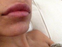 Dr. Peter Lee, MD, FACS, Los Angeles Board Certified Plastic Surgeon Botox Injections Picture