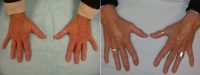 Hand Rejuevnation With Radiesse Before With Doctor Shahram Salemy, MD, FACS, Seattle Plastic Surgeon