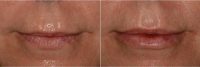 Natural, Soft, And Pillowy Lips With Restylane Silk Before By Dr Andrea Hui, MD, San Francisco Dermatologic Surgeon