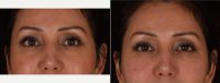 New Innovative Approach To Hyaluronic Acid Injectables Before With Doctor Kian Karimi, MD, FACS, Los Angeles Facial Plastic Surgeon